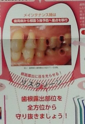 歯の根のむし歯